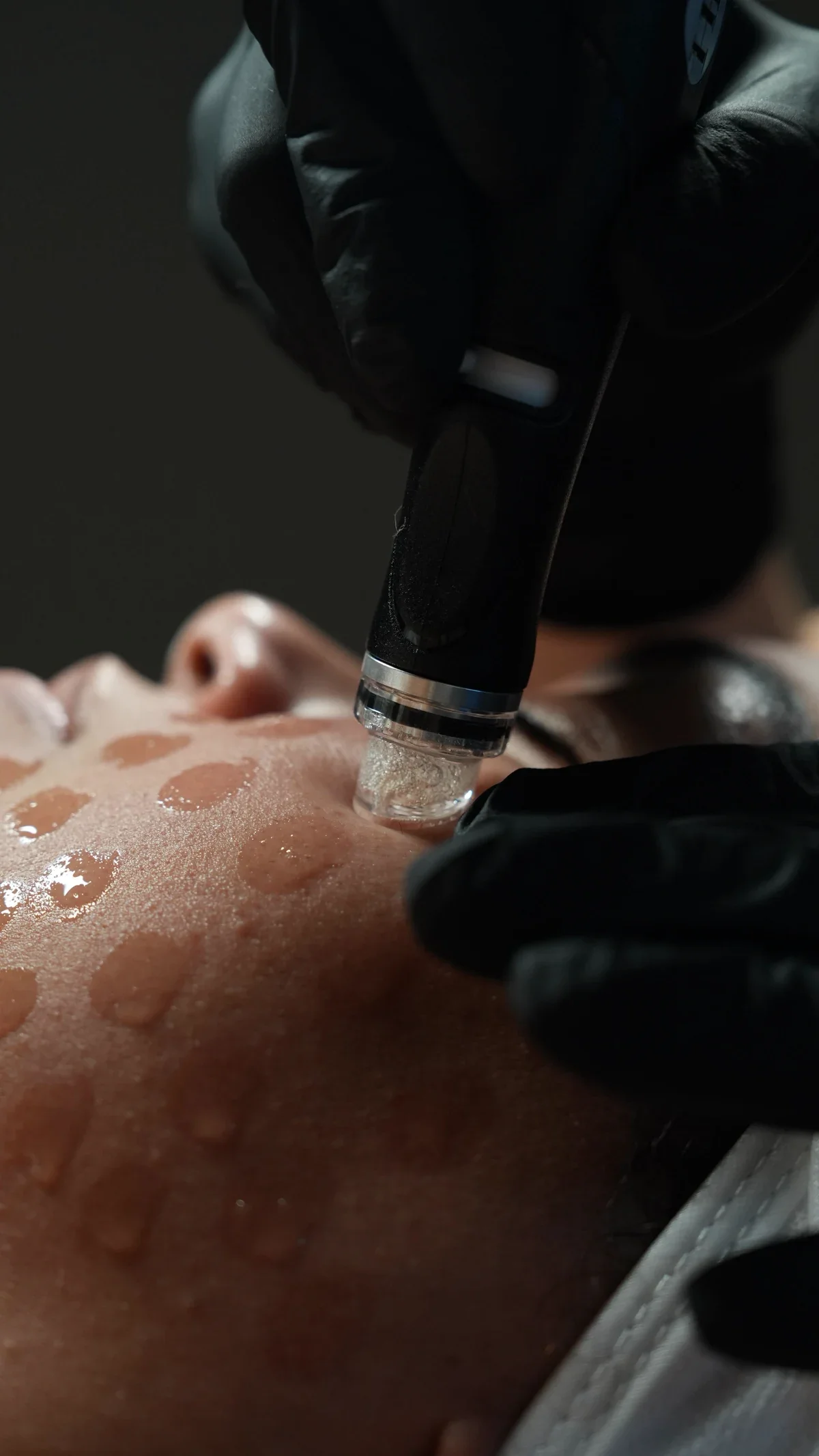 A close-up of a tattooed person's body being treated with a laser device by a practitioner wearing black gloves, with droplets of liquid on the skin.
