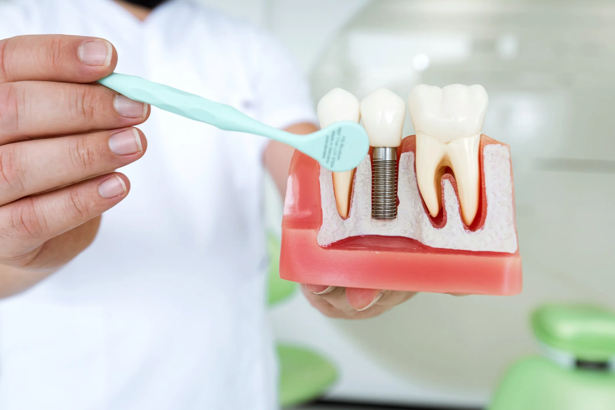 Dental Implant Visual Explanation