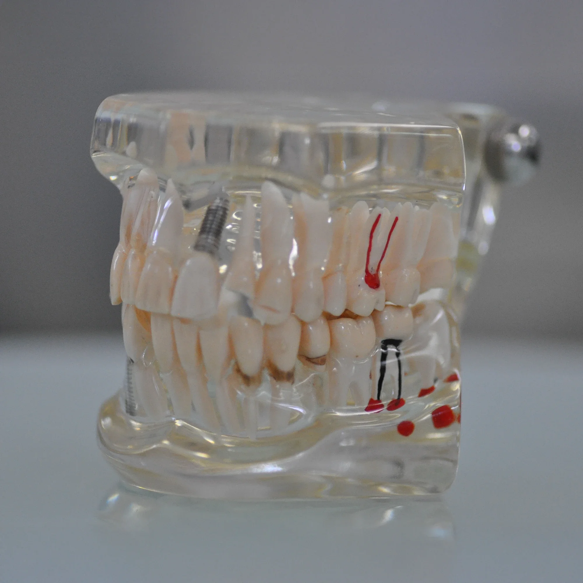 Painless root canal treatment in Pune to remove infection and save your natural tooth.