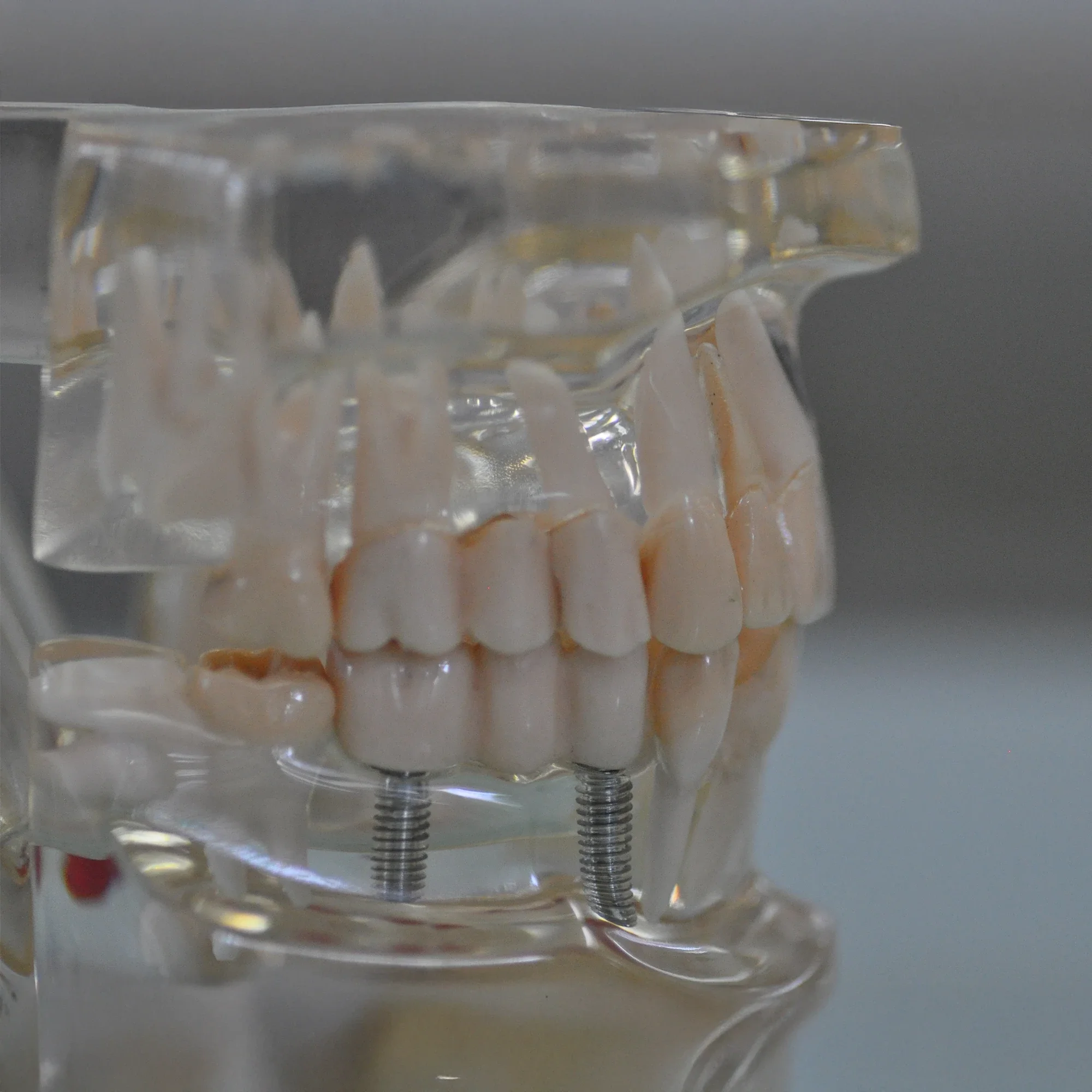 Dental implants in Pune for natural-looking replacement of missing teeth.