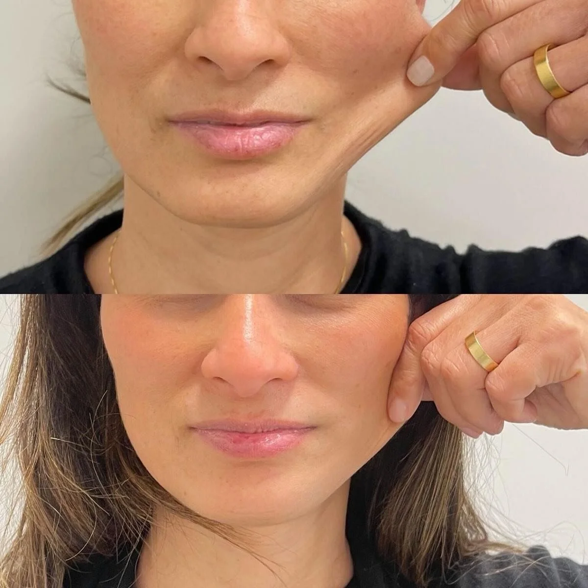 &iquest;Por qu&eacute; Sculptra lleg&oacute; para quedarse? Col&aacute;geno ON ✨
Resultados naturales, progresivos y duraderos.&rdquo;

&iquest;Qu&eacute; hace Sculptra?
✔️ Estimula col&aacute;geno
✔️ Mejora firmeza
✔️ Recupera volumen
✔️ Rejuvenecim