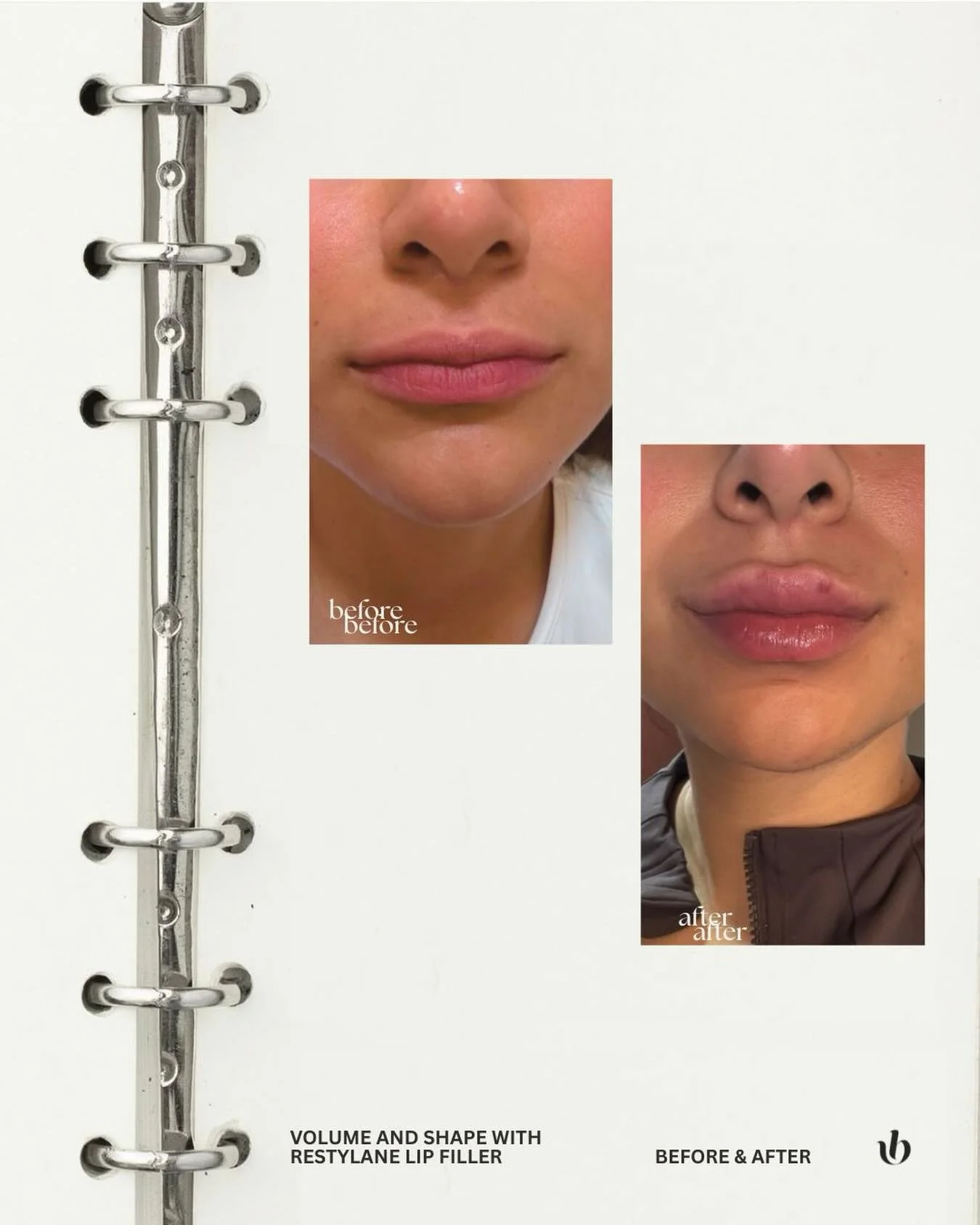 Da volumen y forma con relleno de labios Restylane Kysse. 

The Beauty Bar
📍Fernando Montes de Oca 52 col. Condesa
☎️ 55 1349 9664