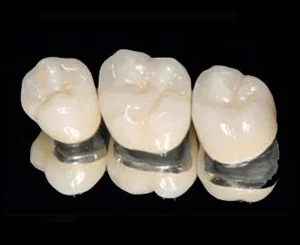 Porcelain Fused to Metal Crowns (Copy)