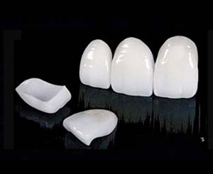 Quantum - Veneers (Copy)