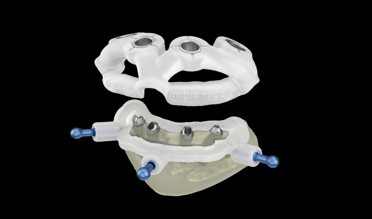 IMPLANT SURGICAL GUIDE (Copy)