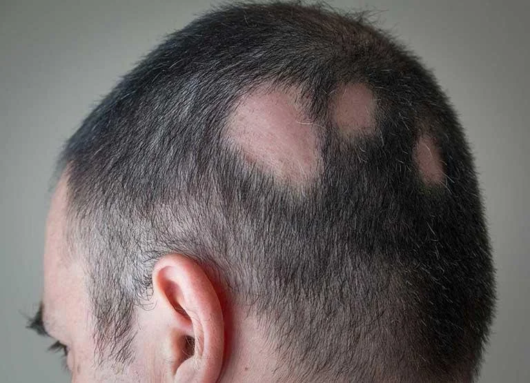 Close-up of the back of a person's head with short hair and visible patches of hair loss consistent with alopecia areata.