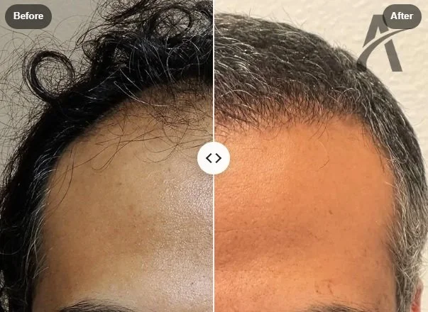 What to Expect After a Hair Transplant: The Complete Month-by-Month Recovery Timeline