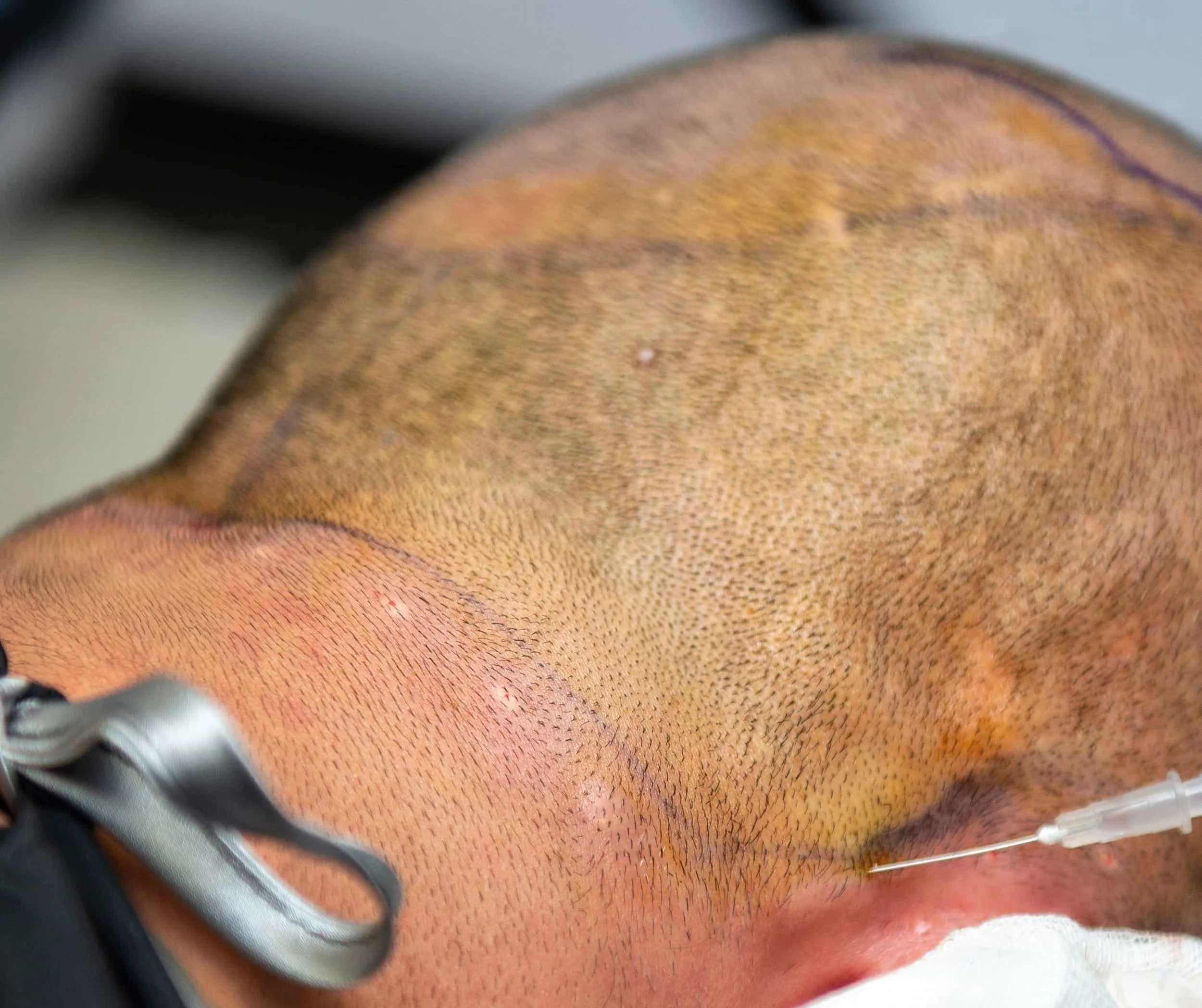Close-up of a person's head with short, dark hair, with a line drawn to indicate the donor area for a hair transplant.