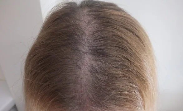 Close-up of a person's scalp with visible thinning hair