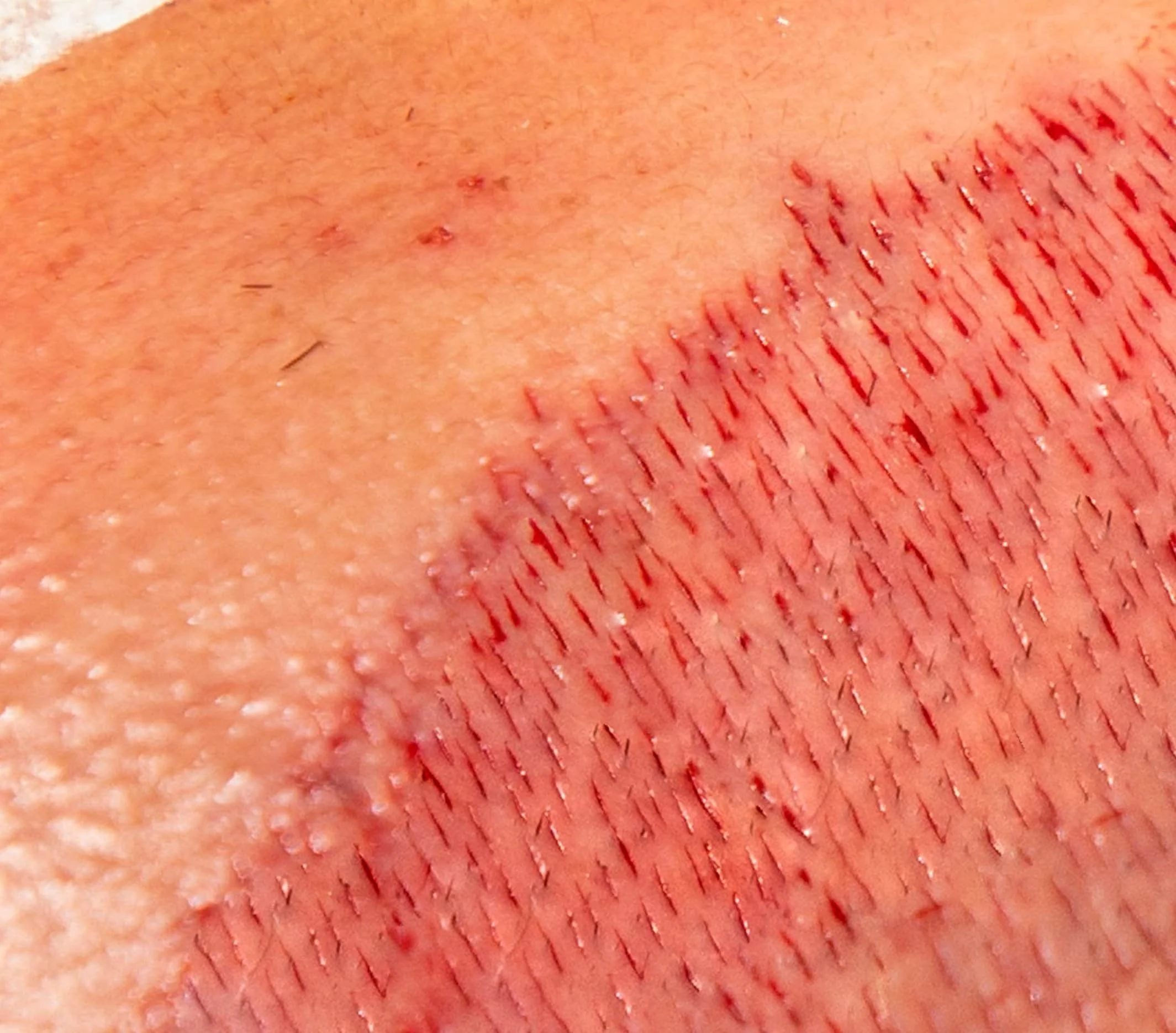 Close-up of recipient incision sites for hair transplantation.