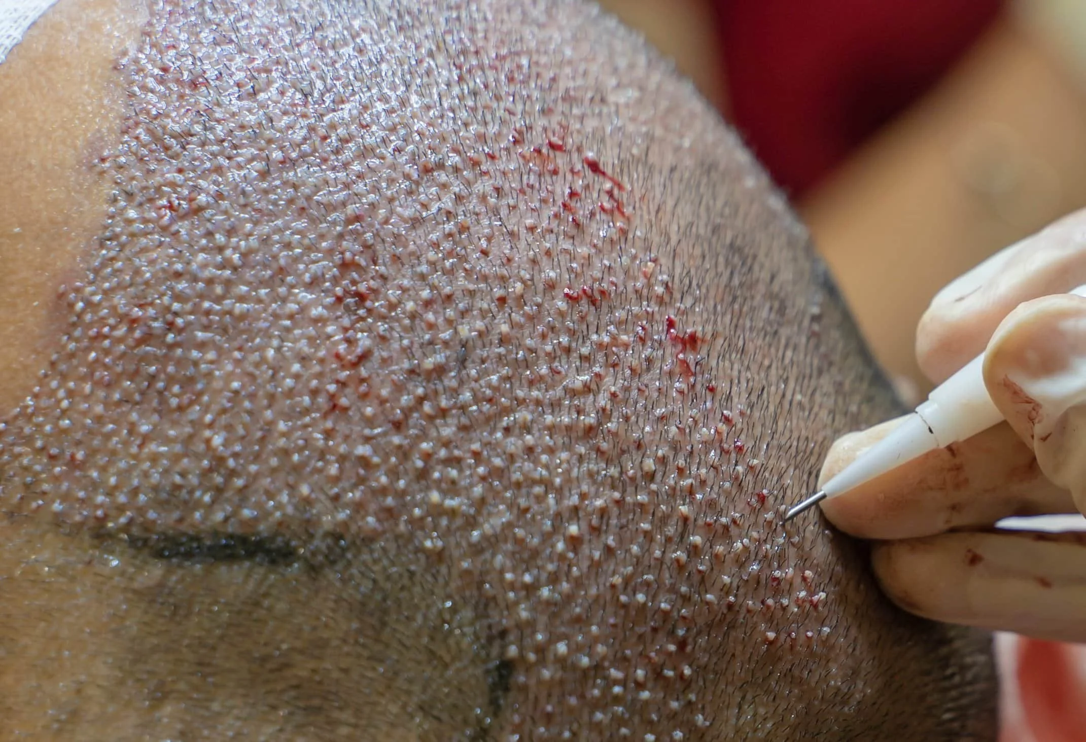 Austin Hair Transplant Implantation