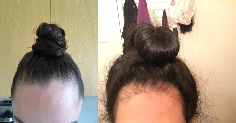 Comparison of two hairstyles with top knots that can lead to traction alopecia.