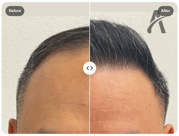 before and after picture of a hair transplant recipient