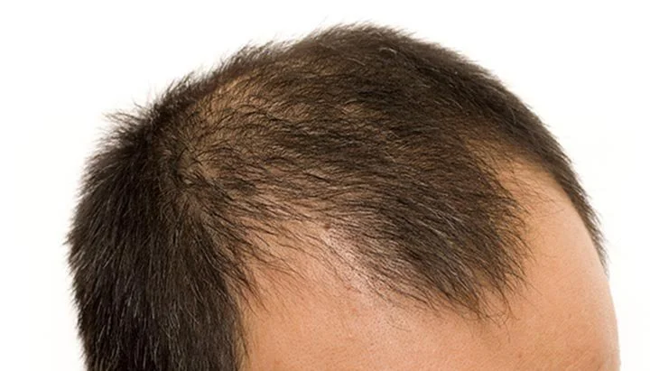 Close-up of a person's scalp with thinning hair and visible scalp area.