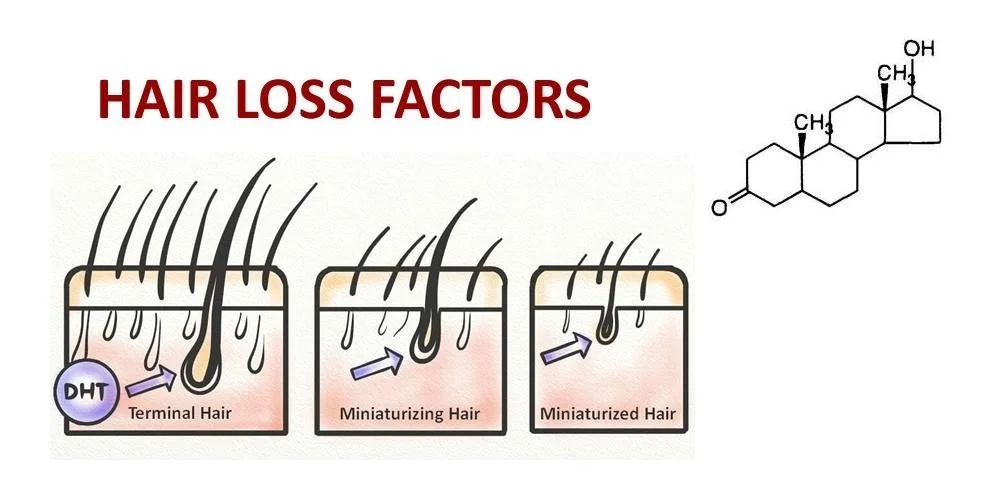 Diagram illustrating hair loss factors, showing three stages: terminal hair, miniaturizing hair, and miniaturized hair, with a chemical structure on the top right.