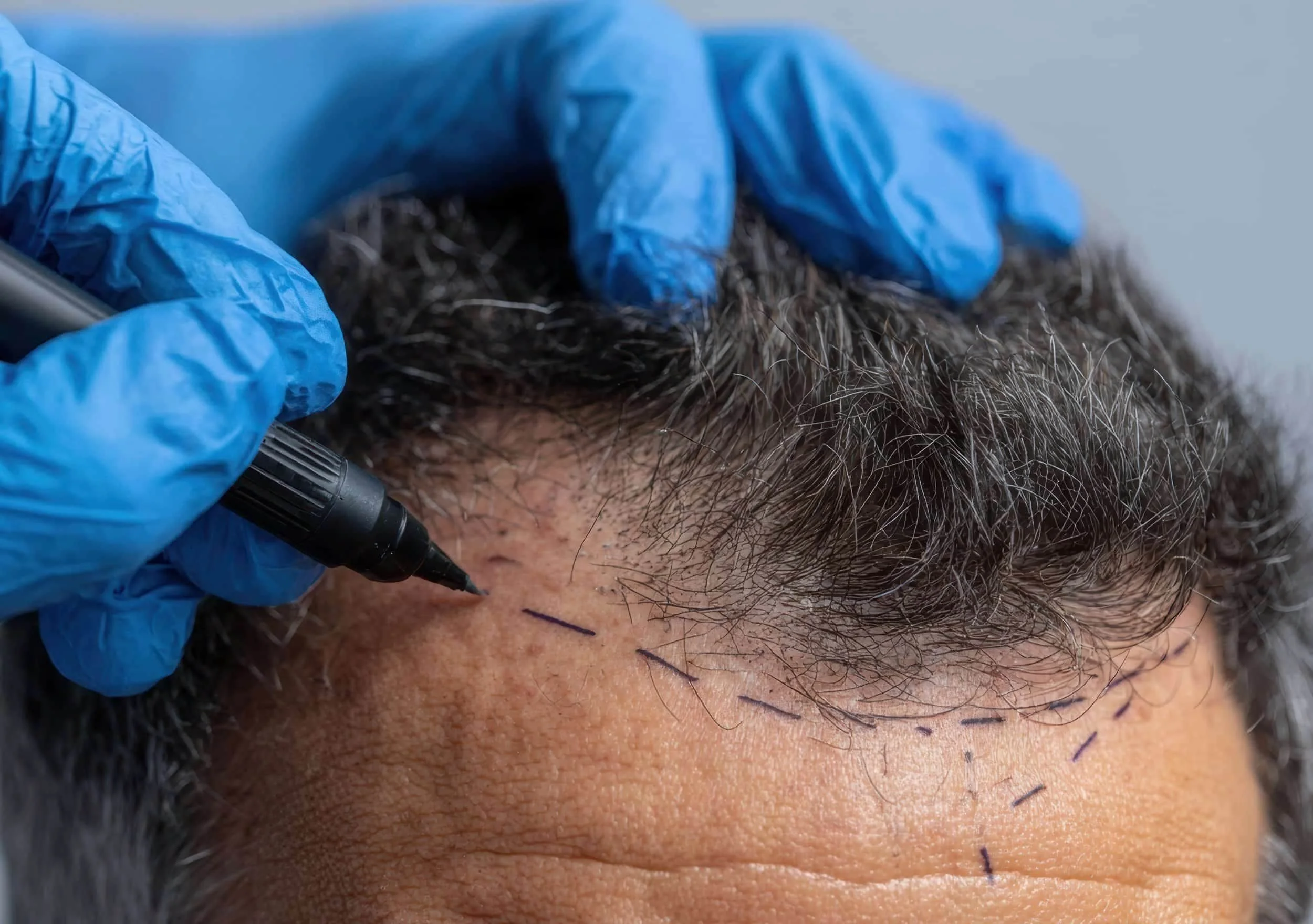 A person having a hairline drawn on for a hair transplant.