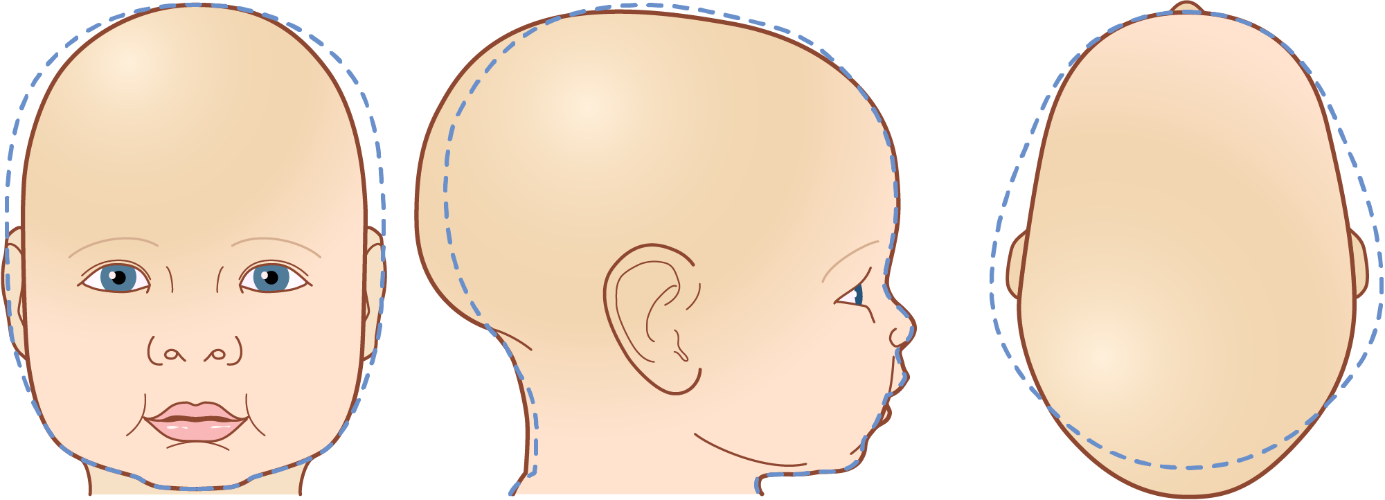 Illustration of three different views of a baby's head with scaphocephaly, showing front, side, and back perspectives. A dashed line is used to represent the optimal head shape.
