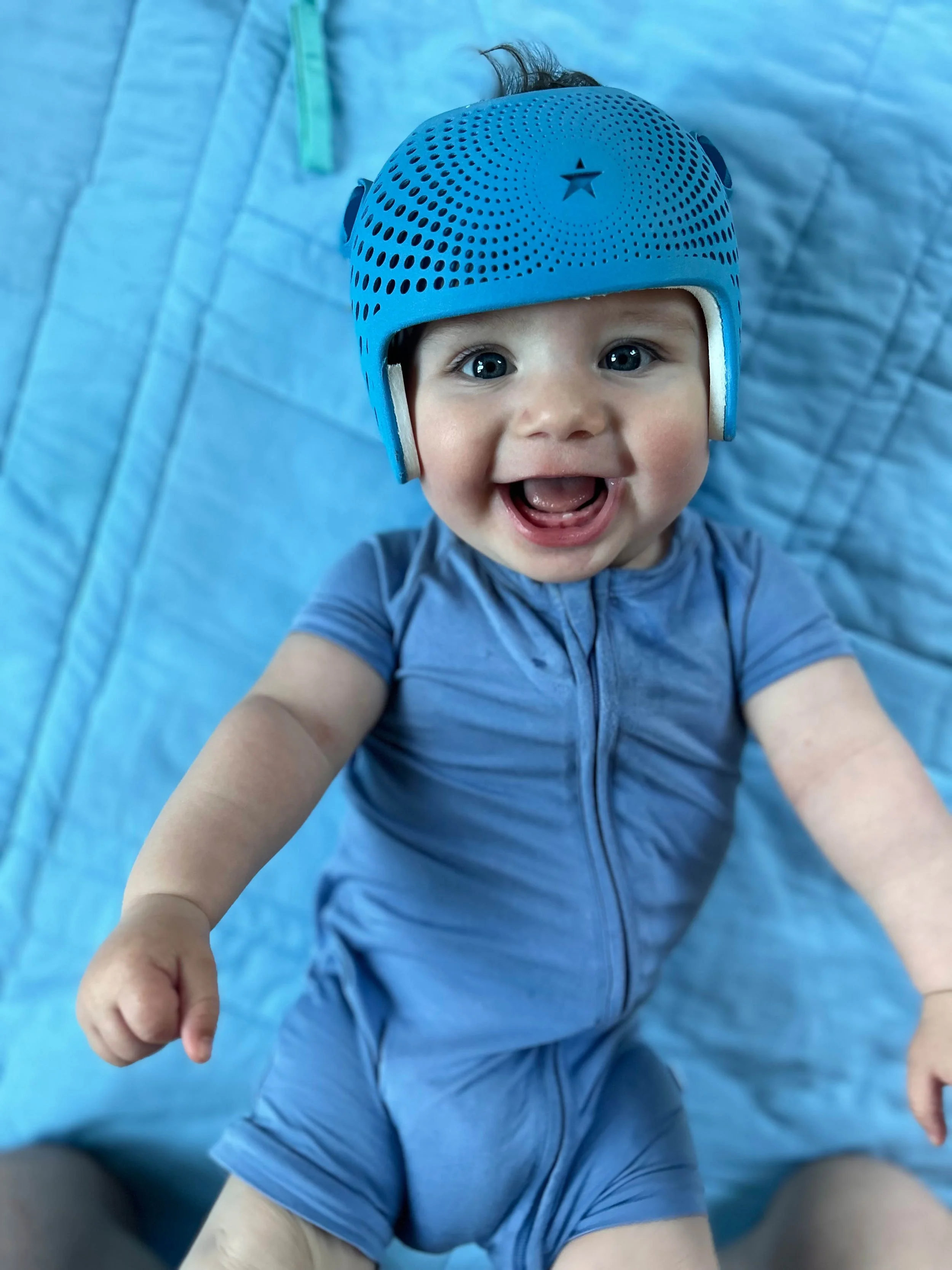 A smiling baby wearing a blue 3D cranial remolding helmet lies on a blue quilted surface, reaching out towards the camera.