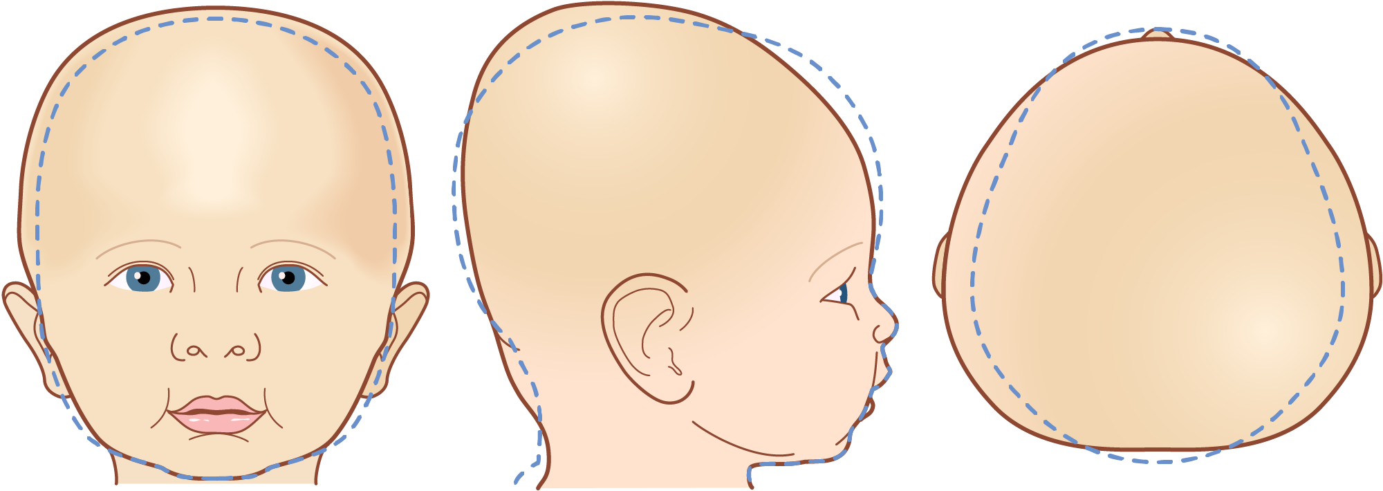 Illustration of three different views of a baby's head with brachycephaly, showing front, side, and back perspectives. A dashed line is used to represent the optimal head shape.