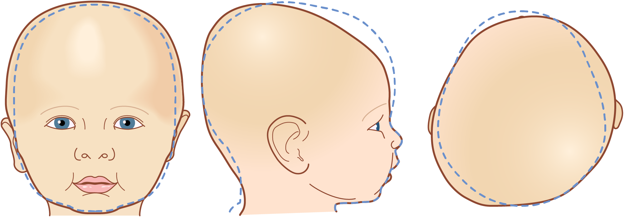 Illustration of three different views of a baby's head with asymmetric brachycephaly, showing front, side, and back perspectives. A dashed line is used to represent the optimal head shape.