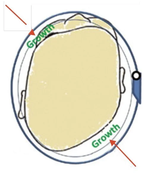 Diagram of a infant's head with plagiocephaly showing the areas of directed growth while utilizing a helmet.