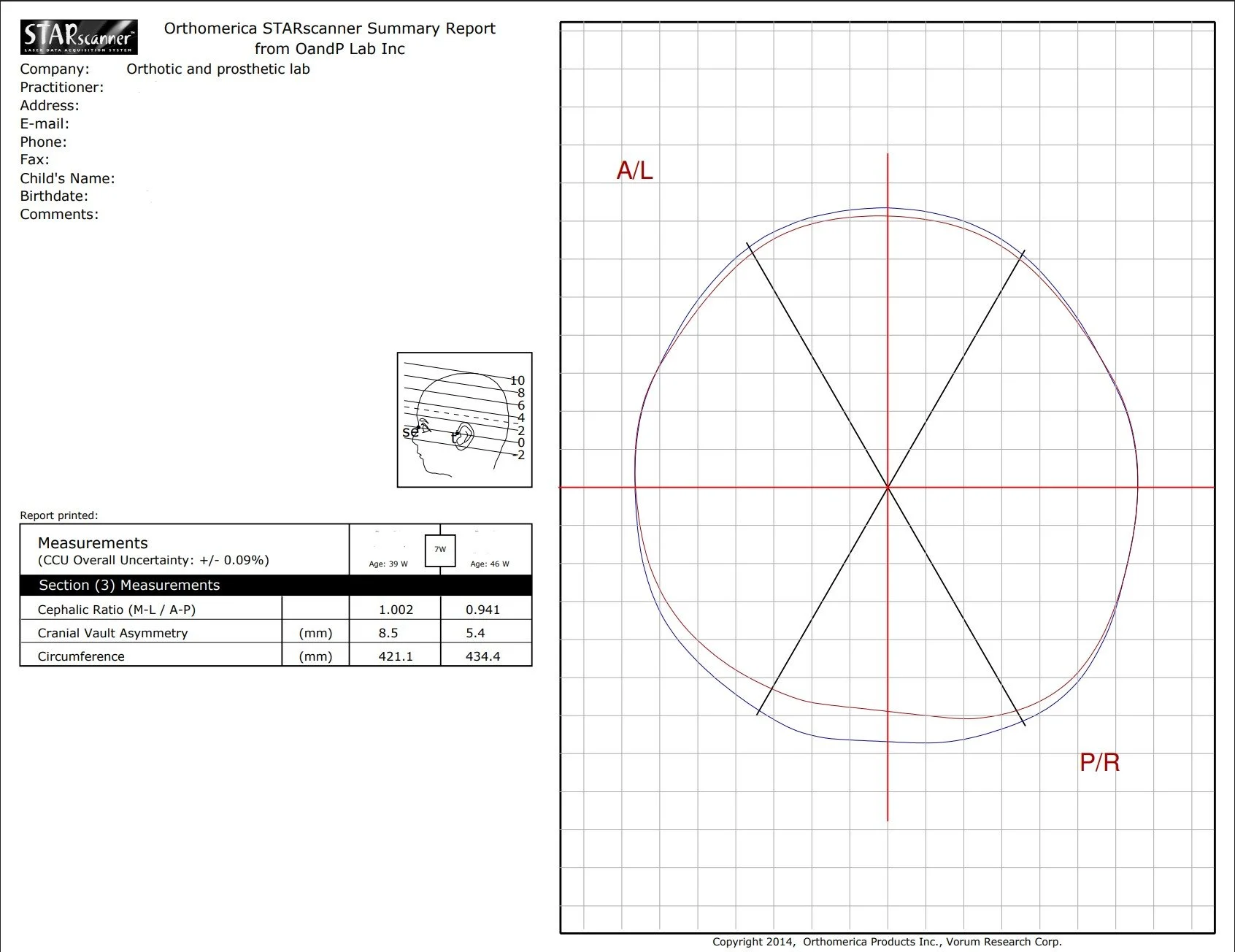 A medical report titled "Orthomerica STARscanner Summary Report" with measurements related to a child's head, including cephalic ratio, cranial vault asymmetry, and circumference, along with a circular chart and technical data.
