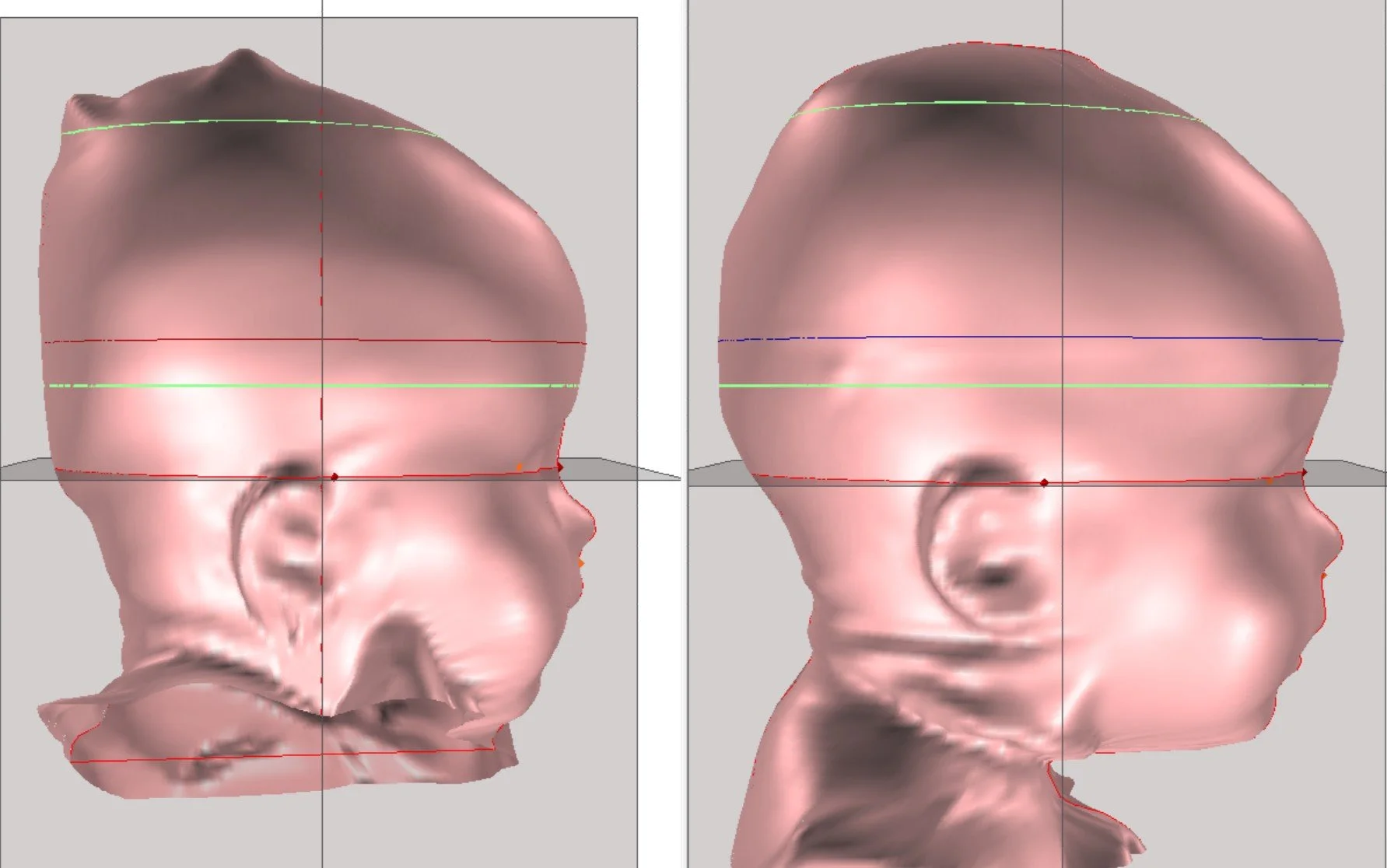 3D medical illustration of an infant's head with brachycephaly viewed from side, showing correction and rounding of the flattened posterior region.