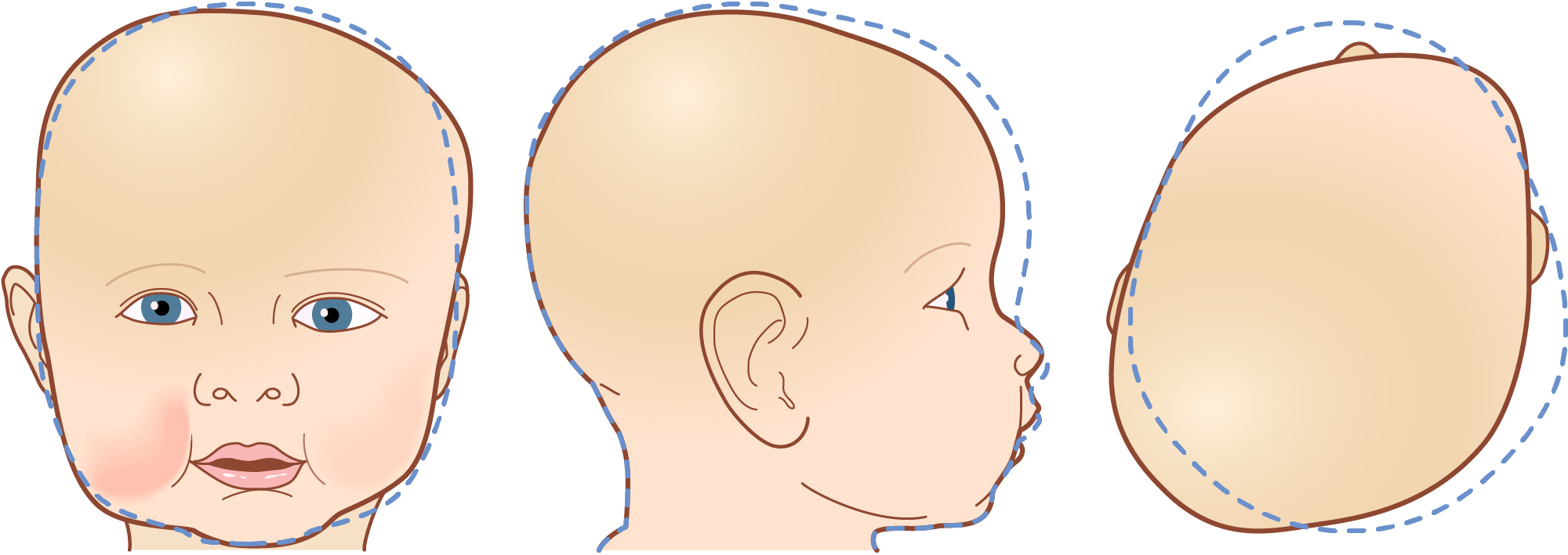 Illustration of three different views of a baby's head with plagiocephaly, showing front, side, and back perspectives. A dashed line is used to represent the optimal head shape.
