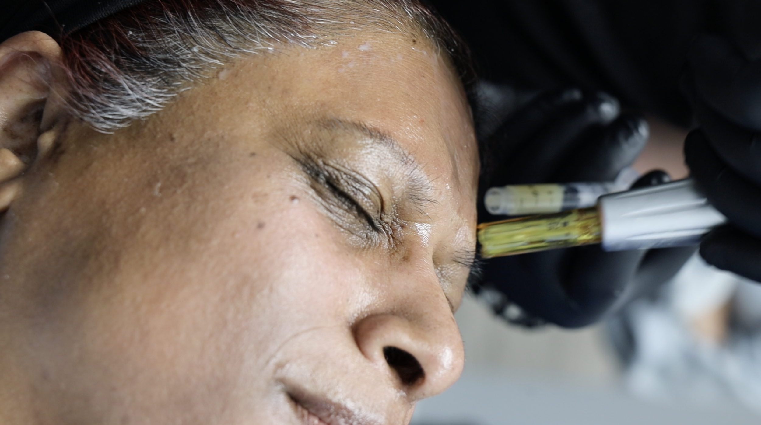 Close-up of a person receiving an injection or vaccination into the cheek, with a healthcare professional's gloved hand holding a syringe near the person's face.