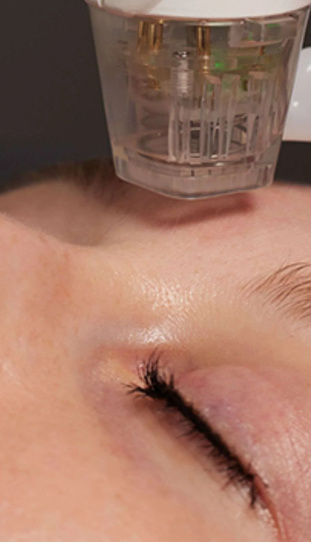Micro Needle