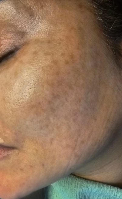 Close-up of a person's cheek showing hyperpigmentation and dark spots.