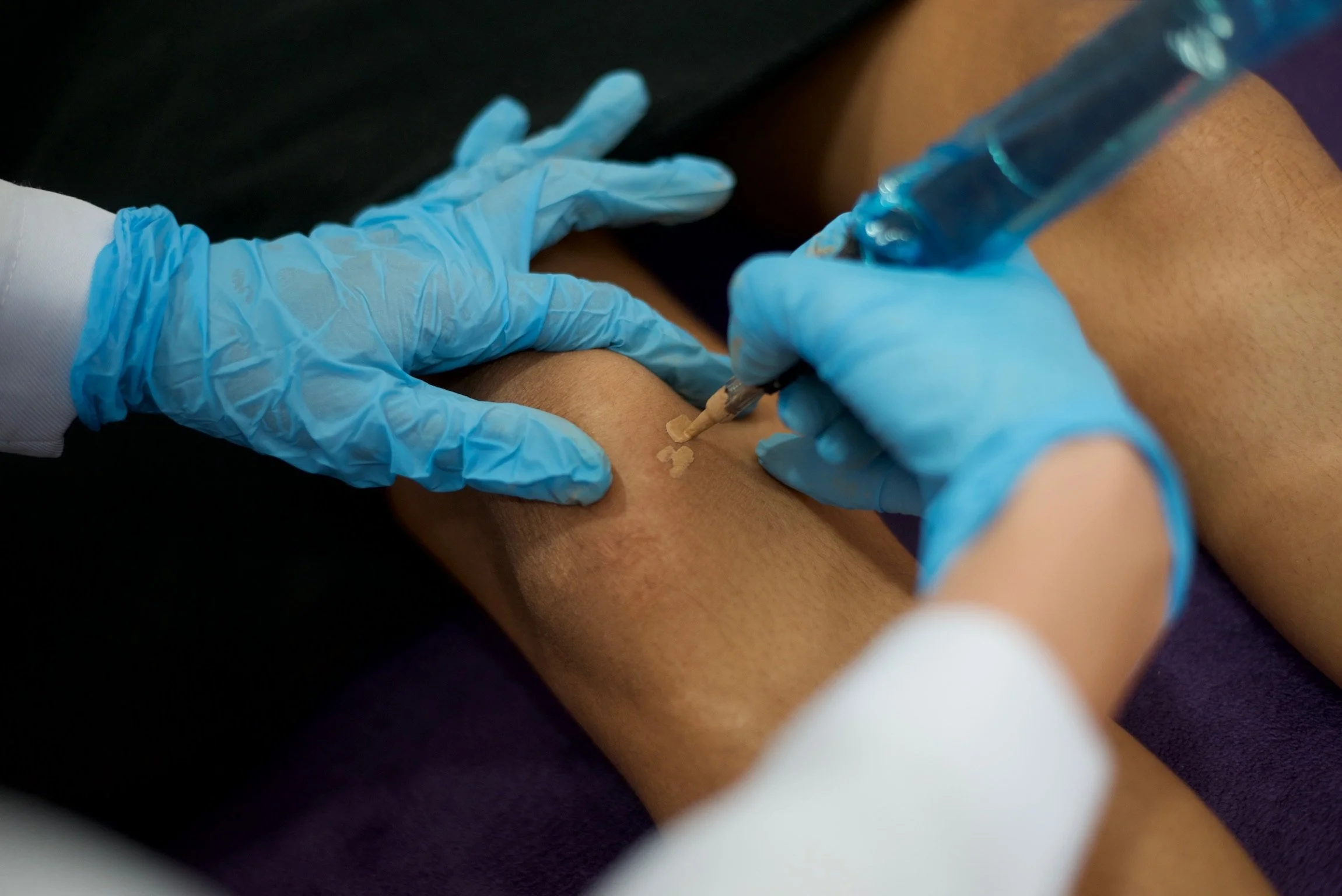 Medical professional in blue gloves applying pigments with a tattoo machine to cover a scar on a patient's leg.