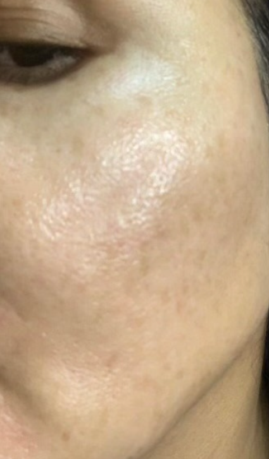 Close-up of a person's cheek and part of their eye showing skin with varely visible acne.