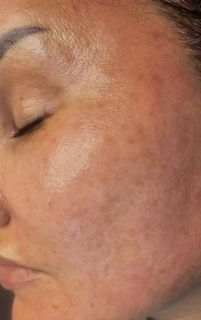 Close-up of a woman's face showing skin with hyperpigmentation and uneven skin tone.