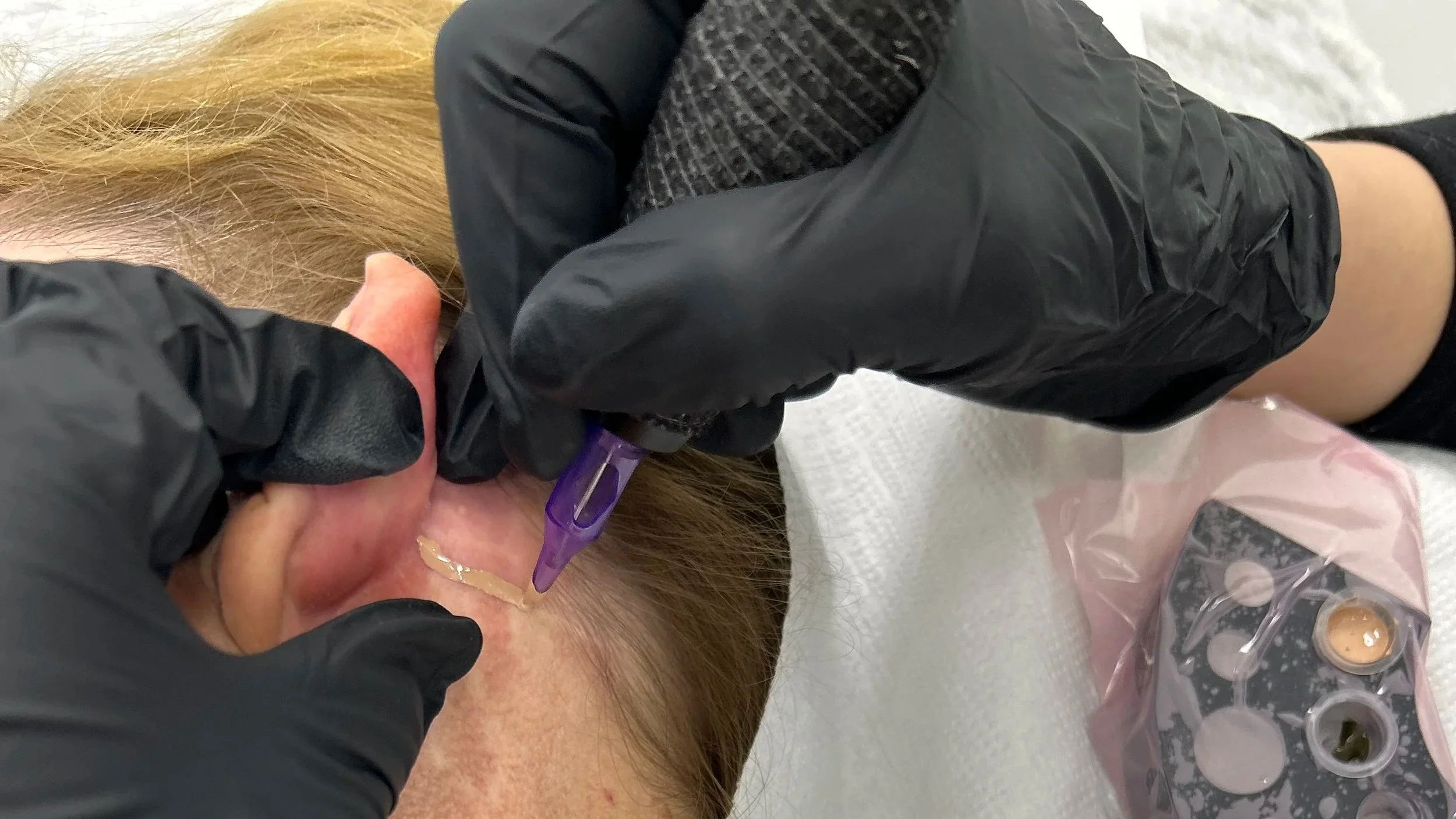 A person receiving a tattoo on the side of their face, with a tattoo needle and ink in use, while wearing black gloves.