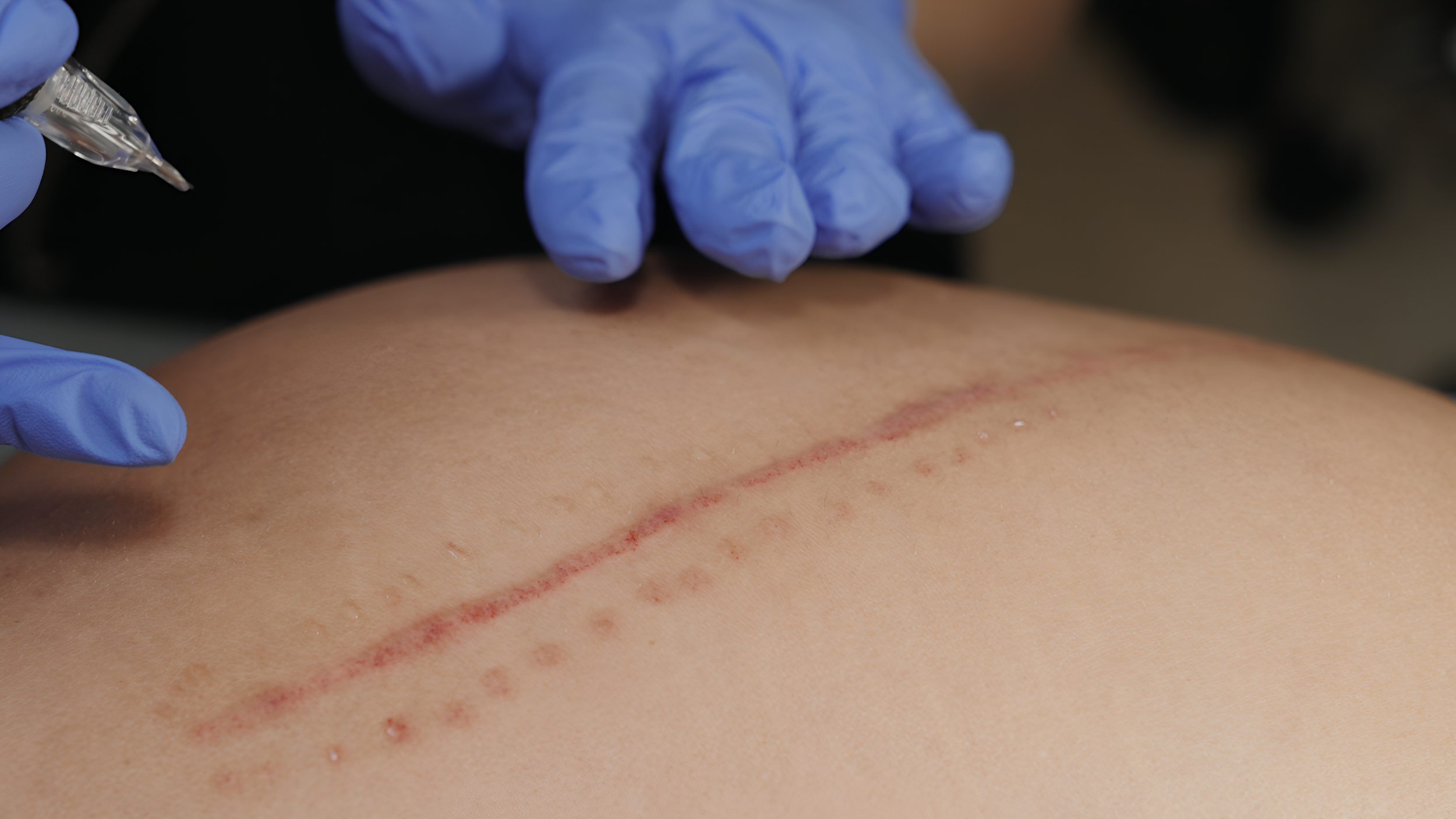 A close-up of a person's back with a recent surgical scar and staples, being examined or treated by a medical professional wearing blue gloves.