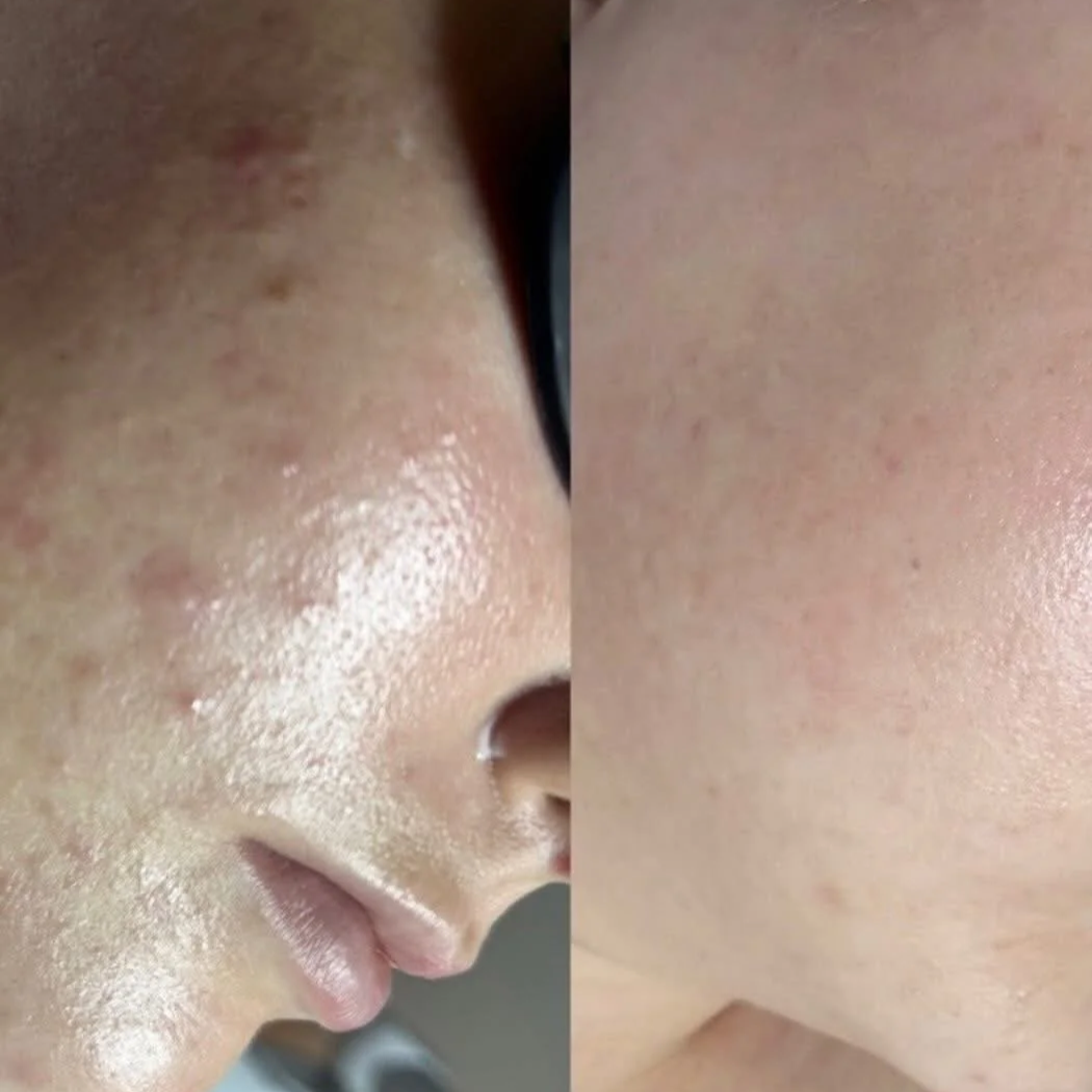 Close-up comparison of a person's facial skin texture before and after skincare treatment, showing improvement in skin smoothness and reduction of bumps or blemishes.