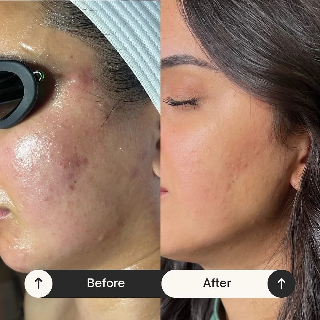 Side-by-side comparison of a woman's face showing skin improvement; before treatment with visible acne, redness, and blemishes, after treatment with clear, smooth skin.