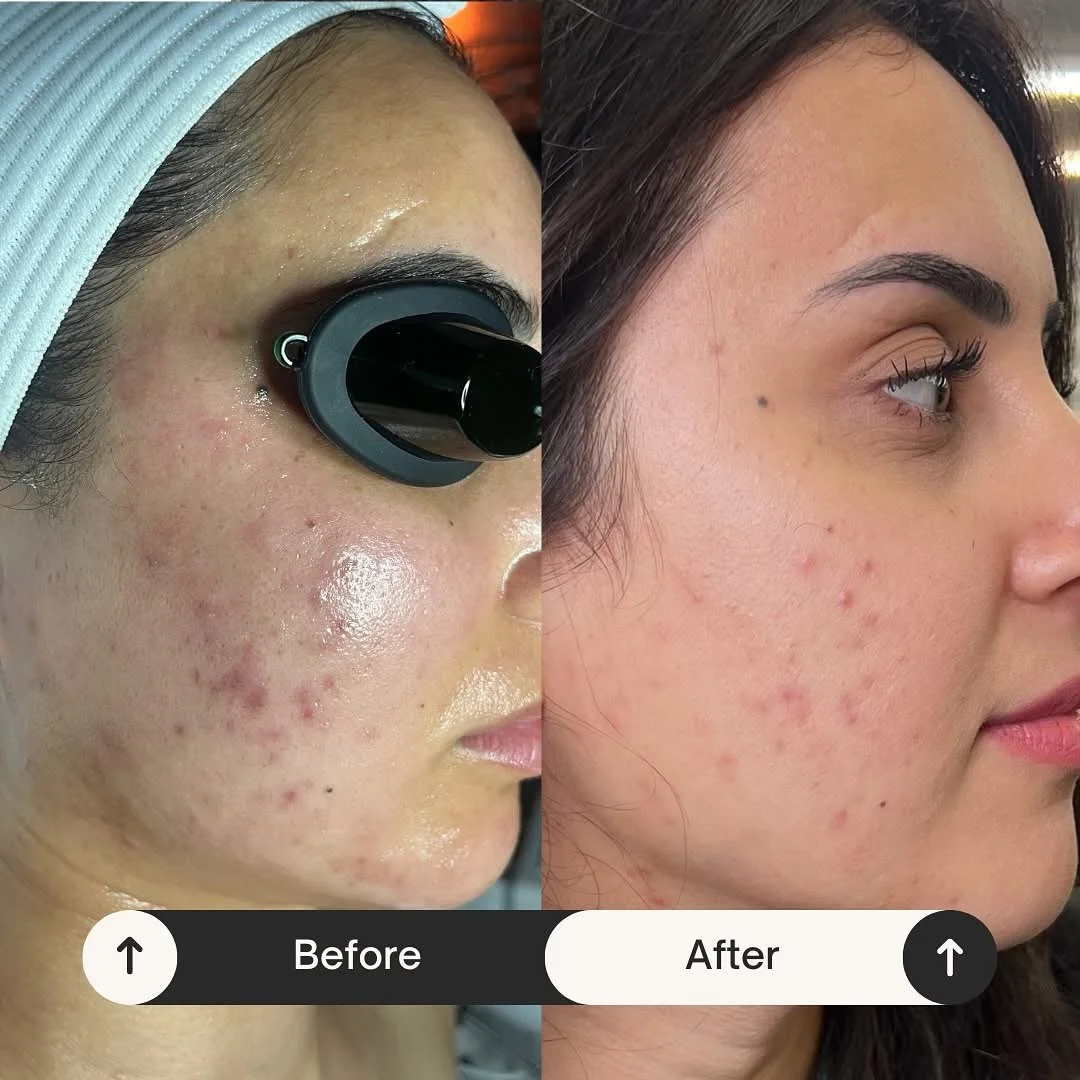 Side-by-side comparison of a woman's face showing improvement in skin condition, with the left side labeled 'Before' and the right side labeled 'After'.