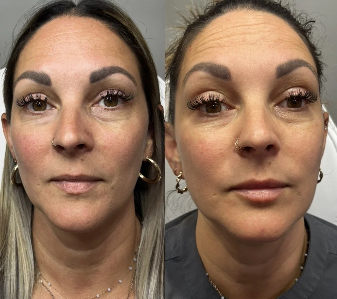 HEALED before & after lip filler