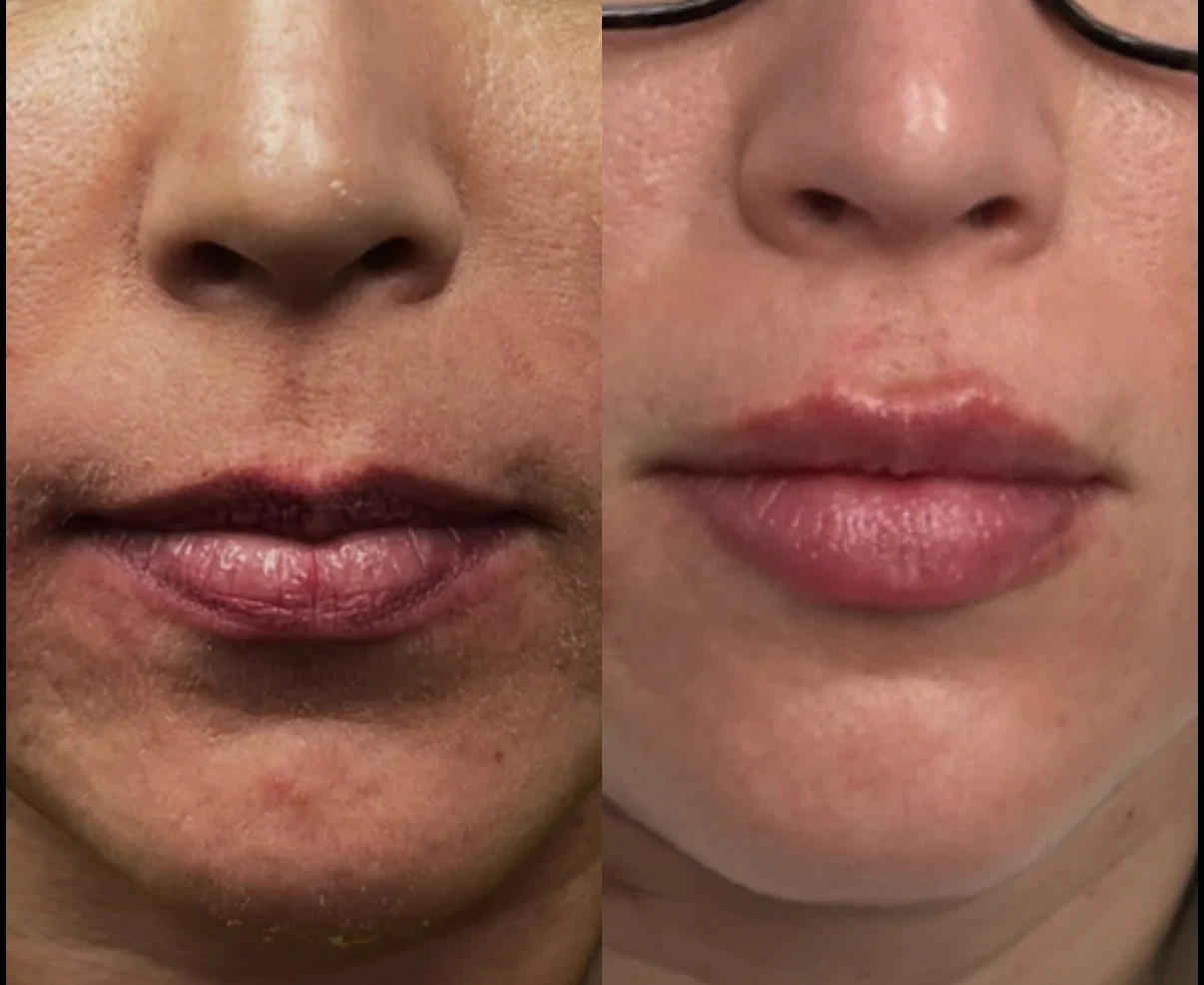 HEALED before & after lip filler