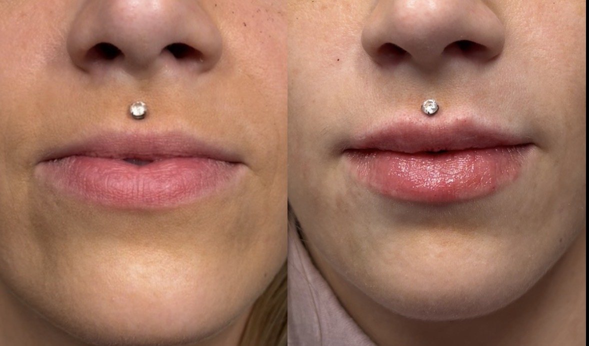 Lip filler before & after- swelling present