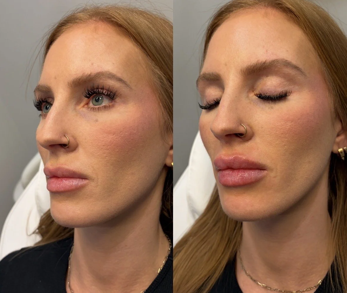 Lip filler before & after- swelling present