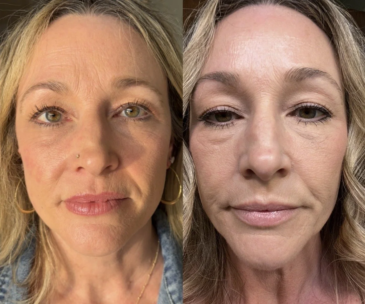 Neurotoxin- between brows and lip flip 2 week before & after