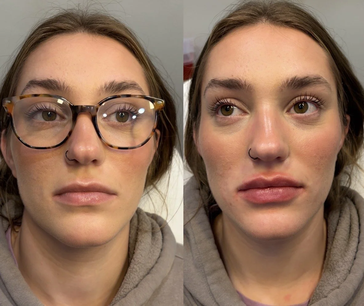 Lip filler before & after- swelling present