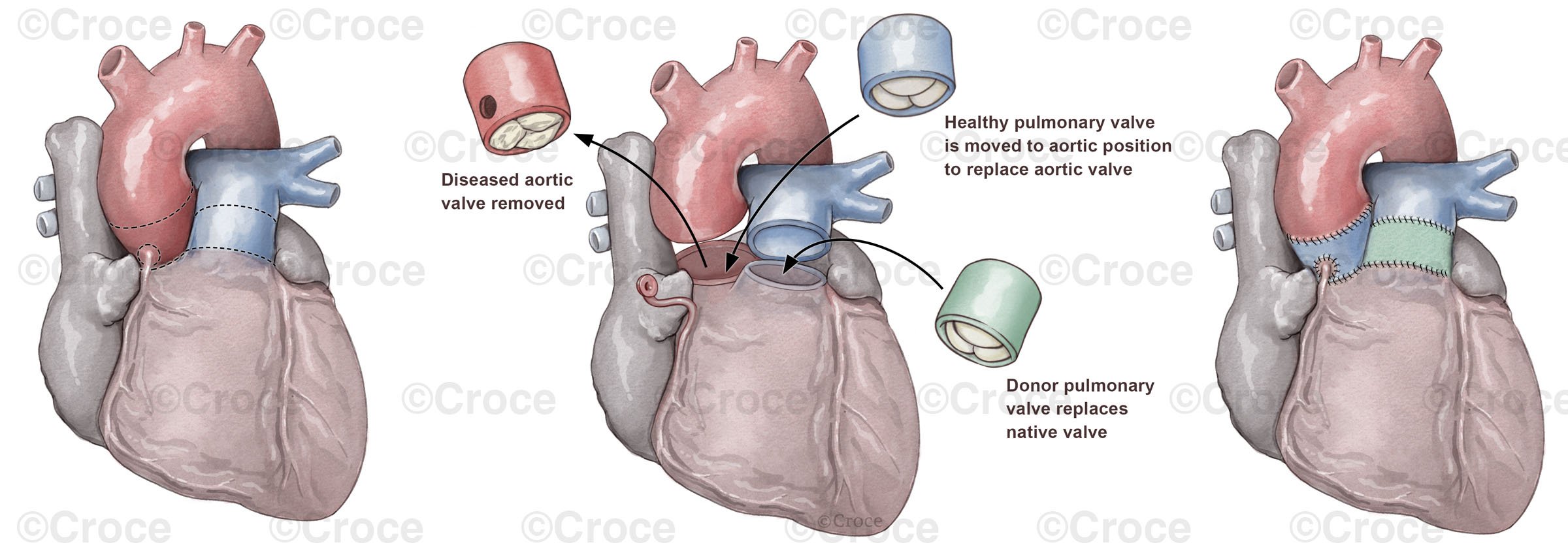 Ross Procedure Heart Valve Repair