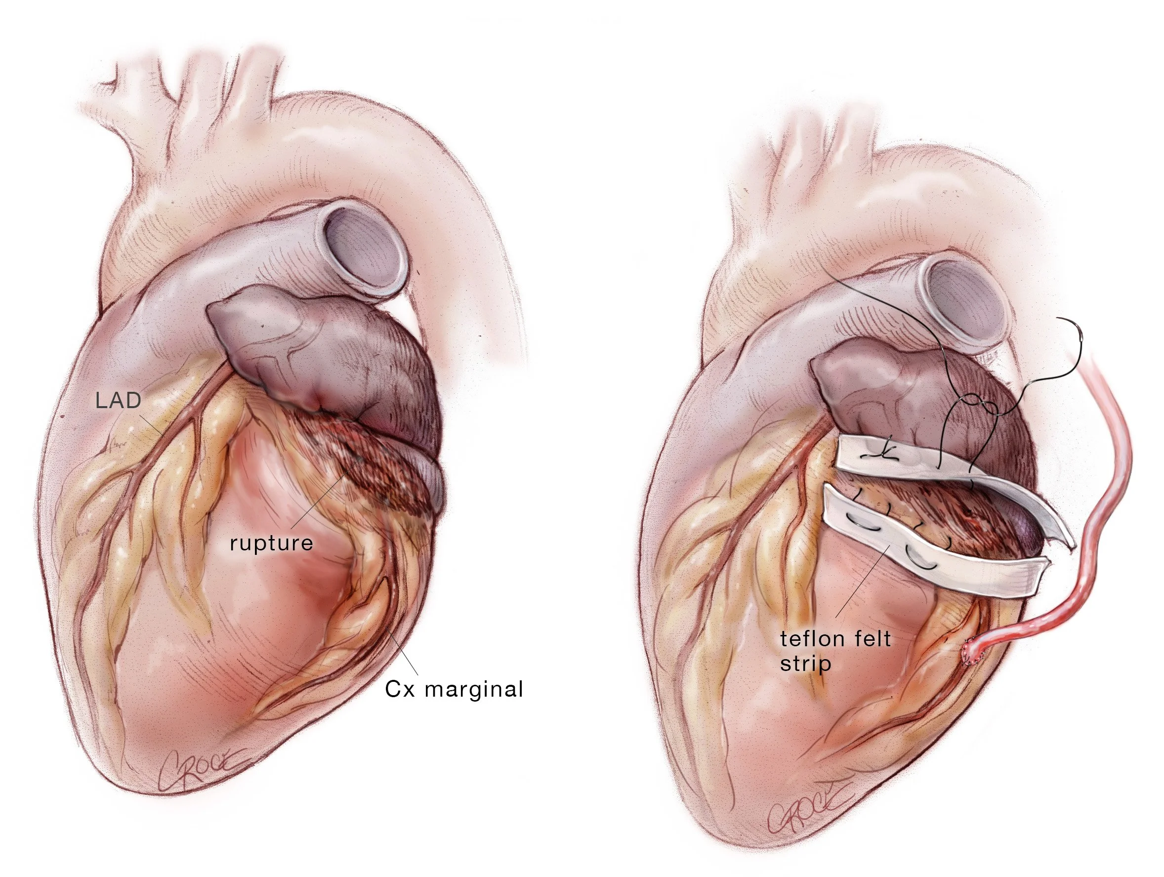 Pledgeted Repair of Posterior Wall Rupture