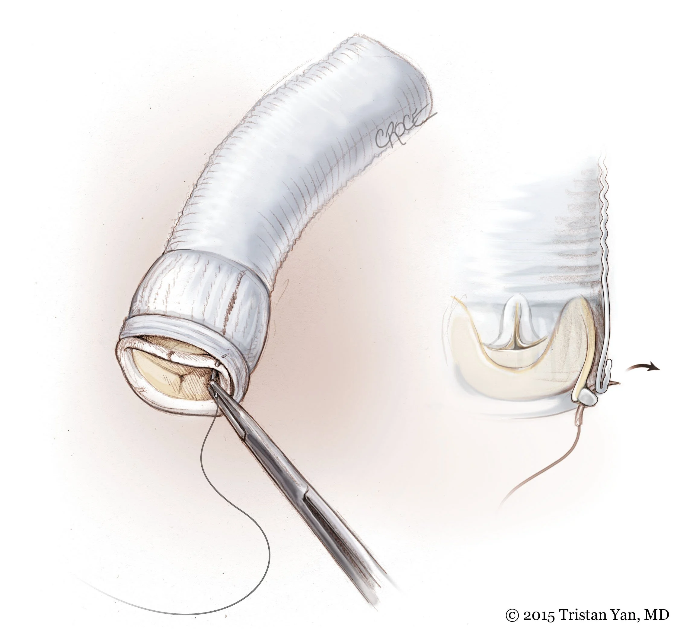 French Cuff Aortic Valve Replacement Technique