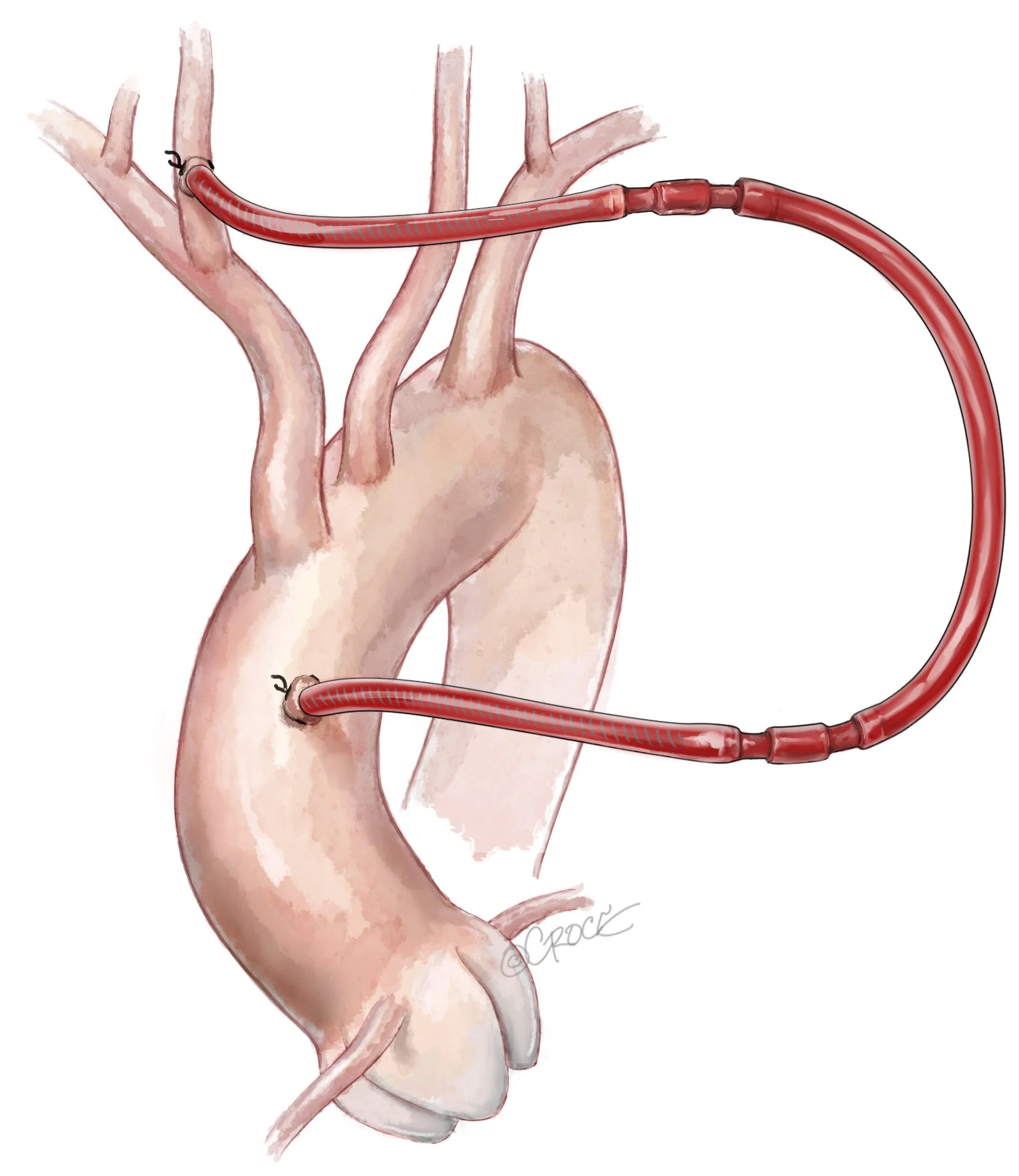 MIS_cerebralshunt_0812.jpg