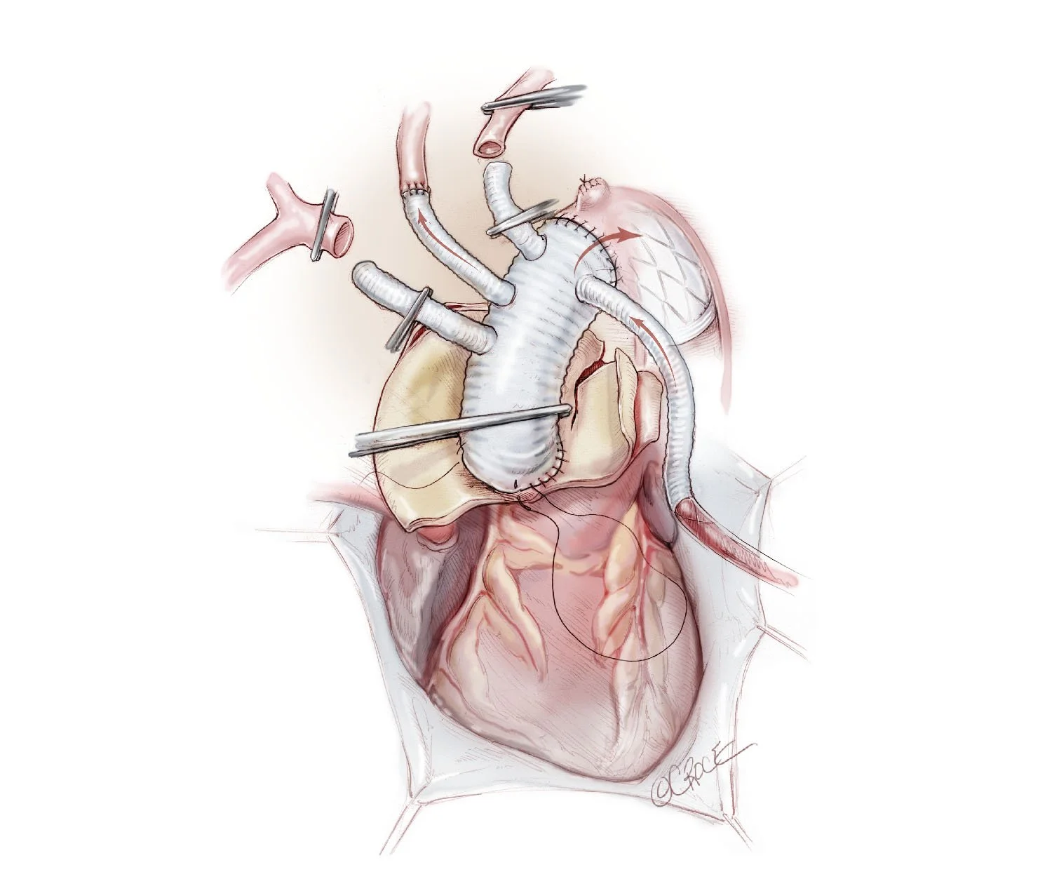 Branch First Aortic Graft